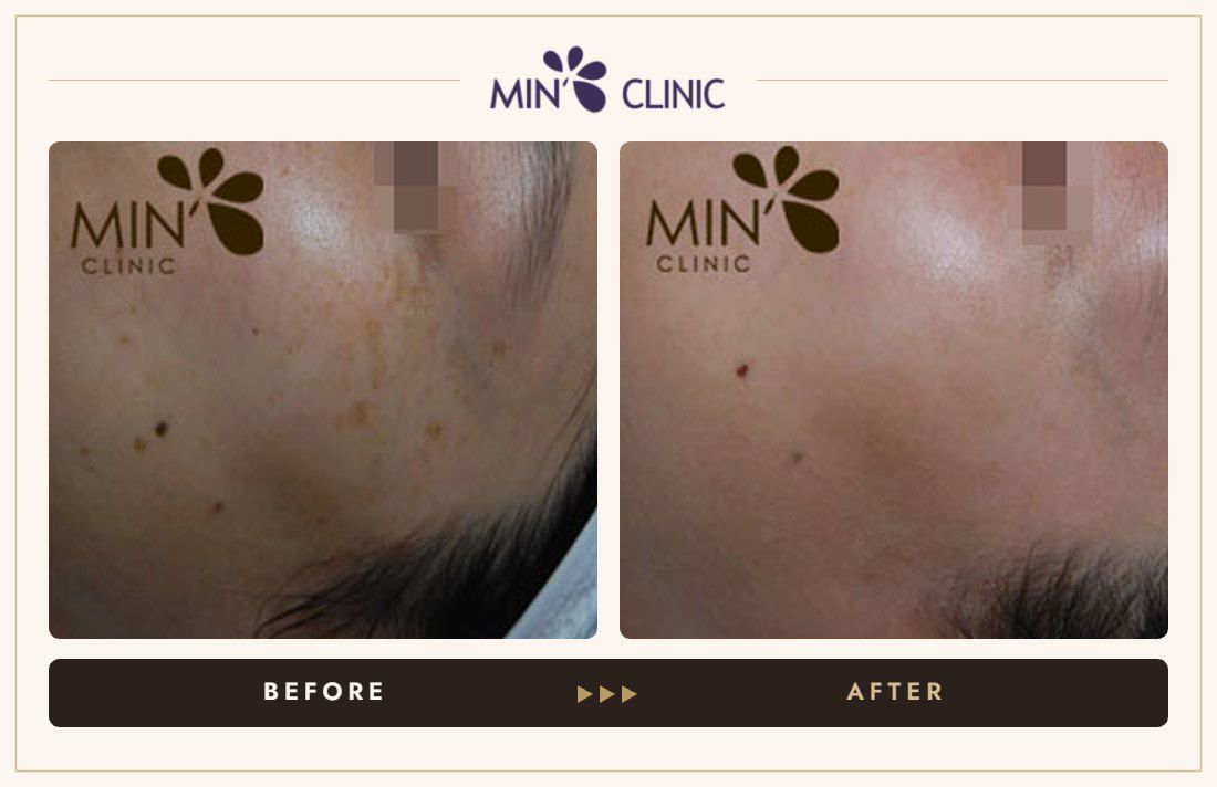 Pigmentation before and after, case 16 – MIN Clinic Seoul