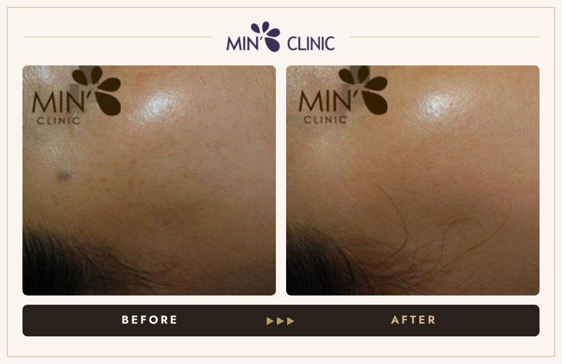 Pigmentation before and after, case 17 – MIN Clinic Seoul
