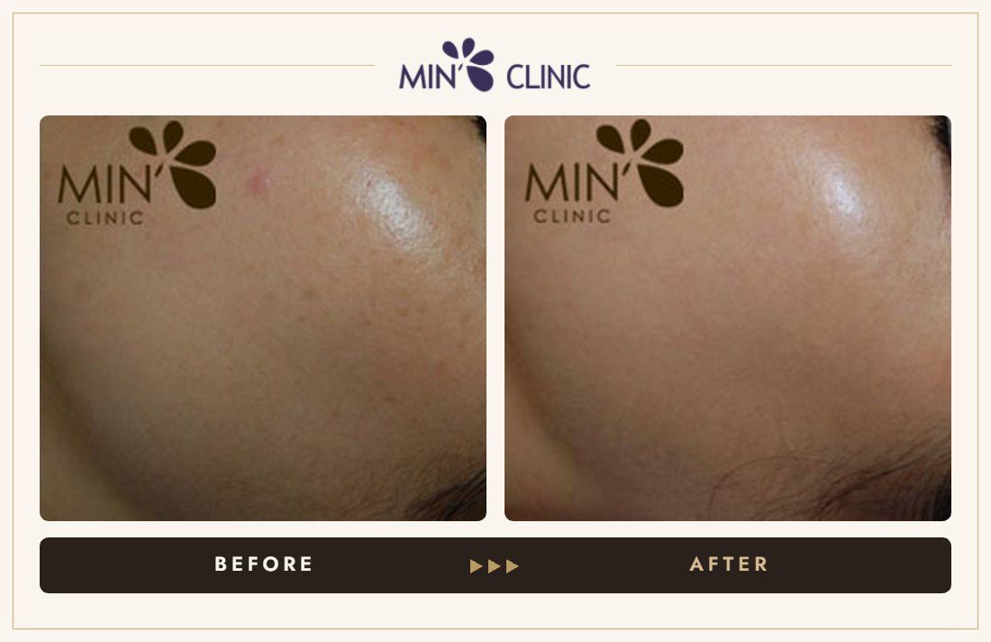 Pigmentation before and after, case 18 – MIN Clinic Seoul