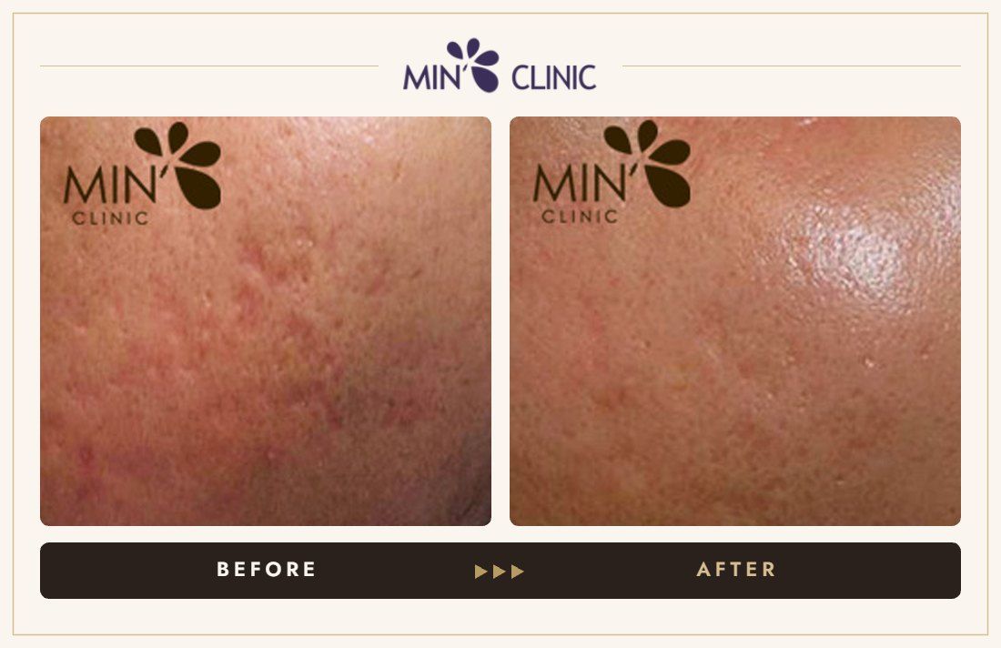 Pores before and after, case 4 – MIN Clinic Seoul