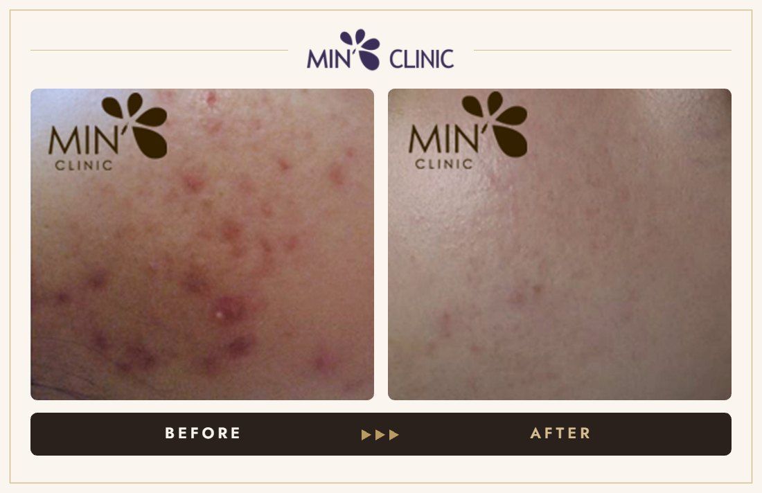 Acne before and after, case 47 – MIN Clinic Seoul