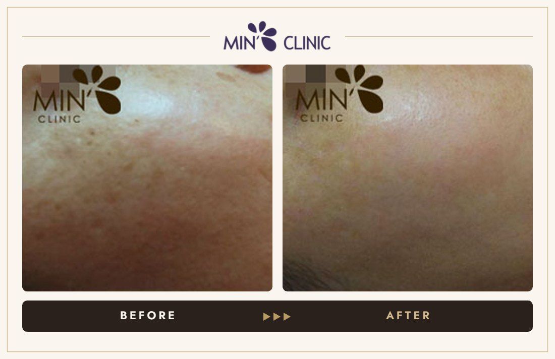 Pigmentation before and after, case 19 – MIN Clinic Seoul
