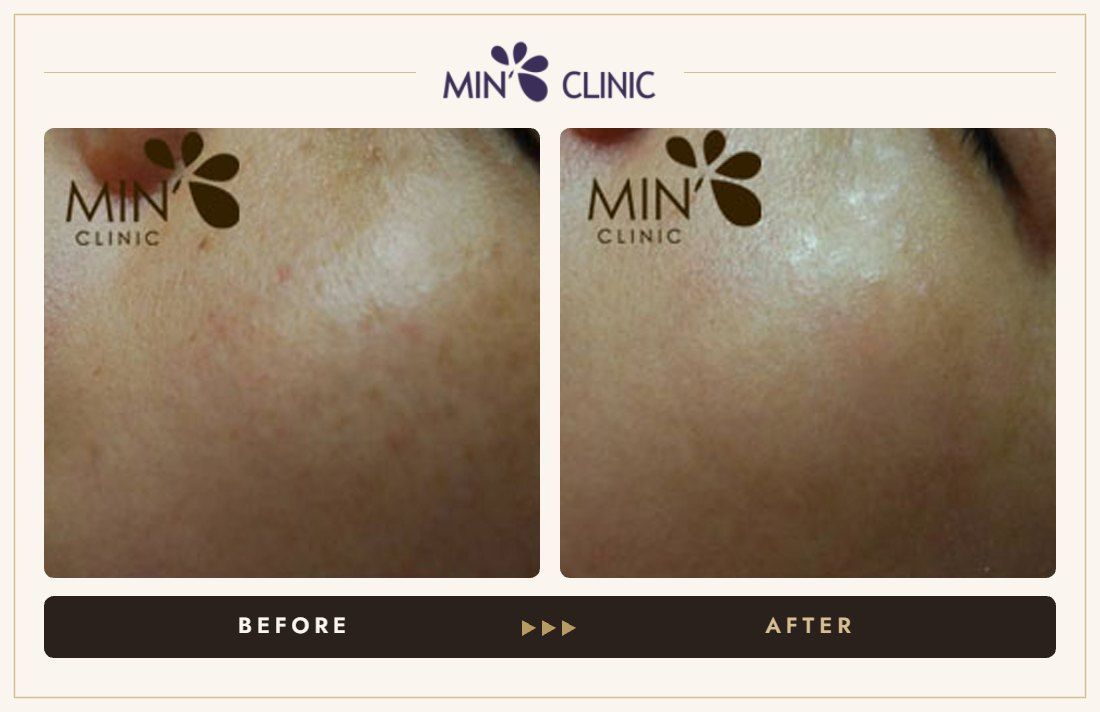 Pigmentation before and after, case 20 – MIN Clinic Seoul