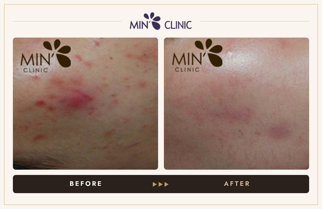 Acne before and after, case 48 – MIN Clinic Seoul