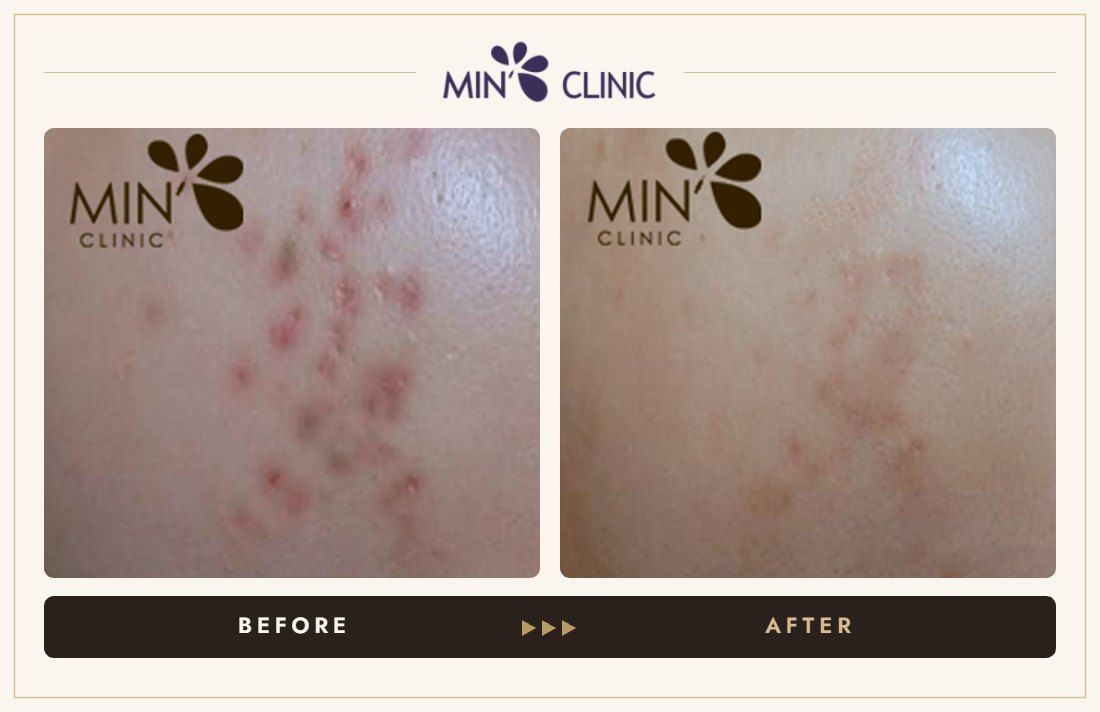 Acne before and after, case 49 – MIN Clinic Seoul