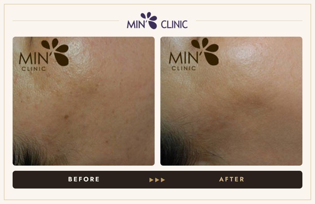 Pigmentation before and after, case 21 – MIN Clinic Seoul