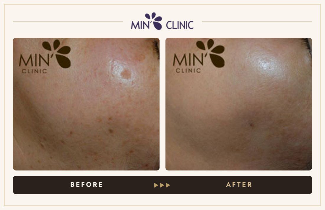 Pigmentation before and after, case 22 – MIN Clinic Seoul