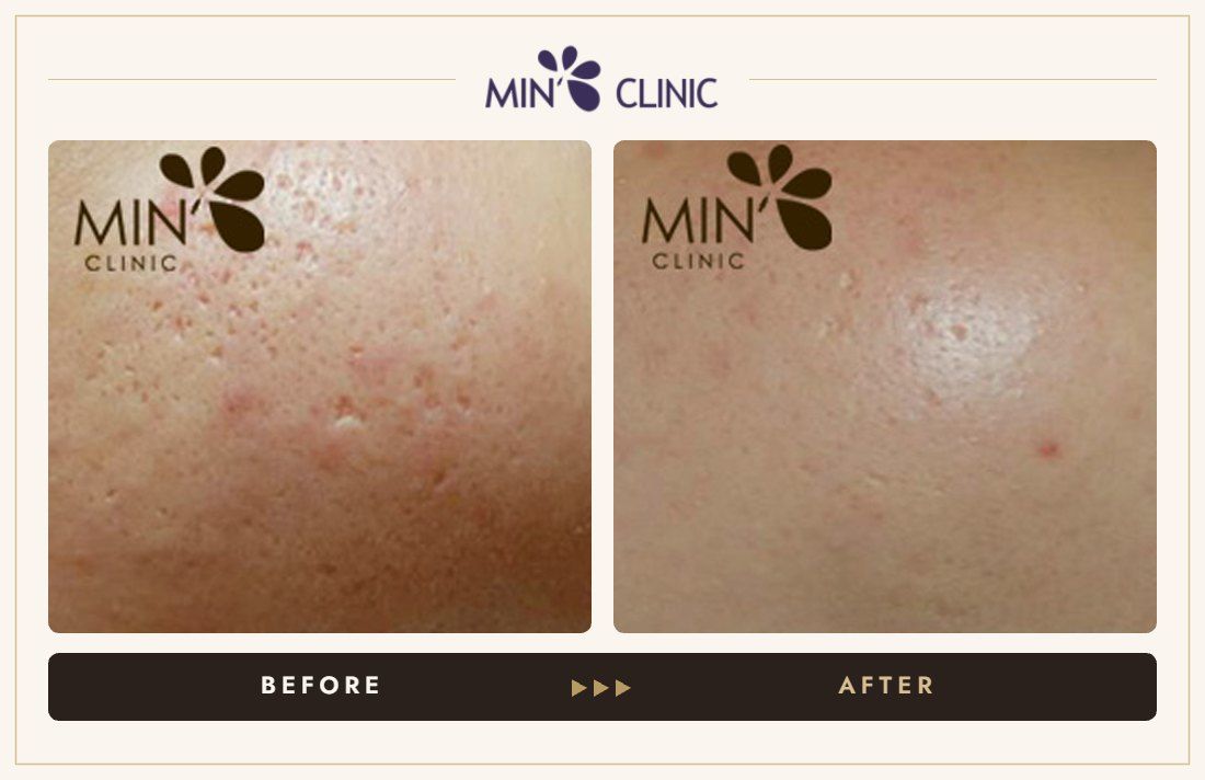 Pores before and after, case 5 – MIN Clinic Seoul