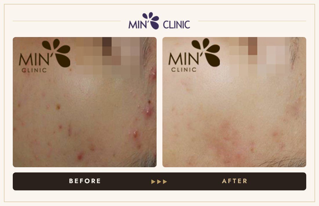 Acne before and after, case 50 – MIN Clinic Seoul