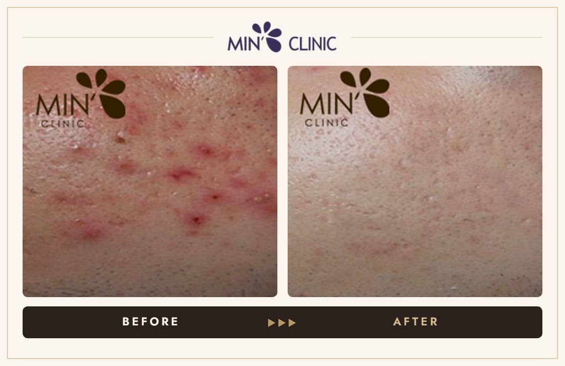 Acne before and after, case 51 – MIN Clinic Seoul