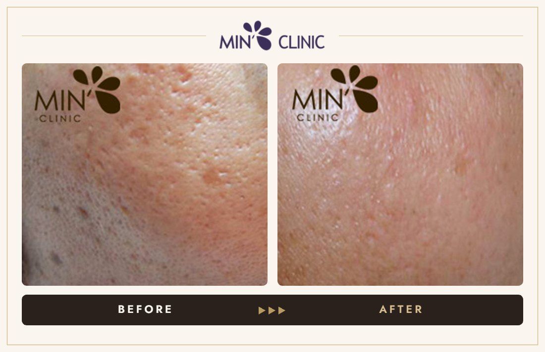 Pores before and after, case 6 – MIN Clinic Seoul