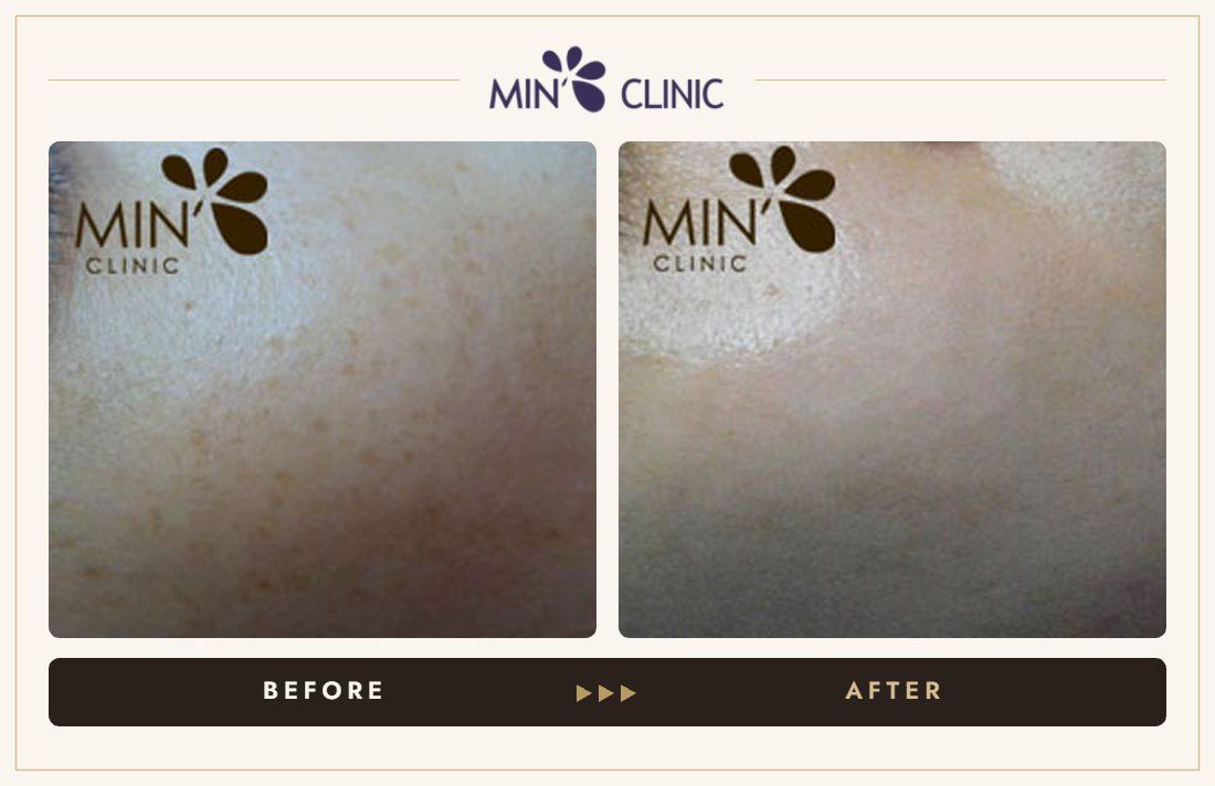 Pigmentation before and after, case 23 – MIN Clinic Seoul