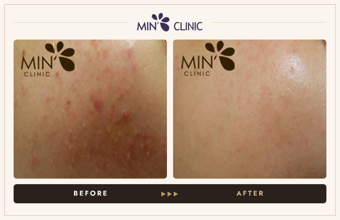 Acne before and after, case 52 – MIN Clinic Seoul
