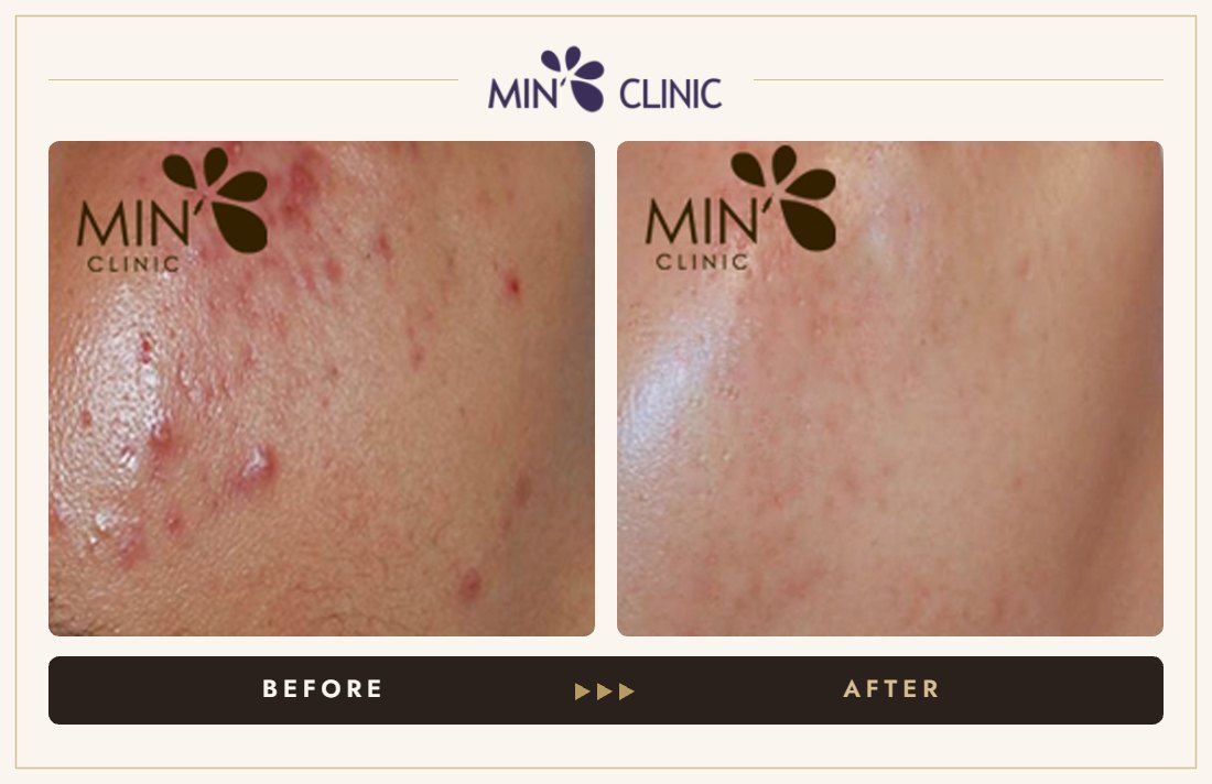 Acne before and after, case 53 – MIN Clinic Seoul