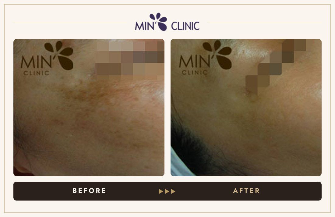 Pigmentation before and after, case 24 – MIN Clinic Seoul