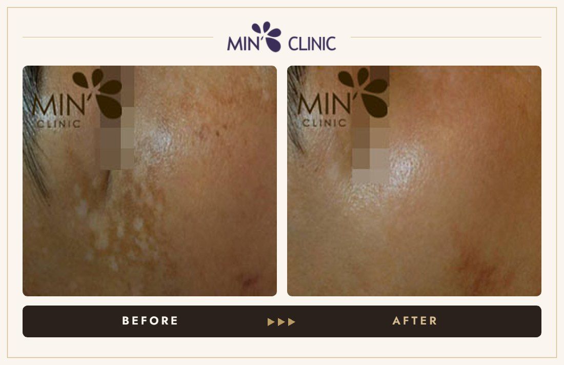 Pigmentation before and after, case 25 – MIN Clinic Seoul