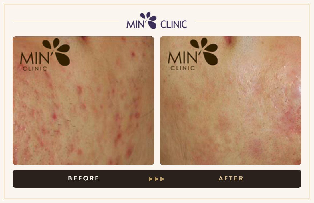 Acne before and after, case 54 – MIN Clinic Seoul