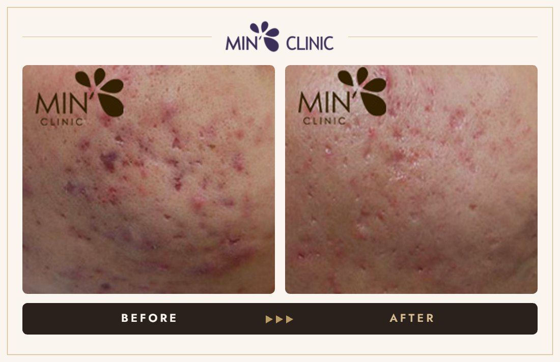 Acne before and after, case 55 – MIN Clinic Seoul