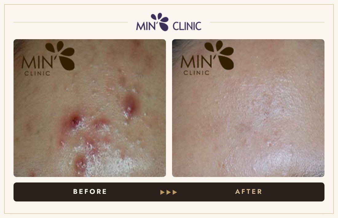 Acne before and after, case 56 – MIN Clinic Seoul