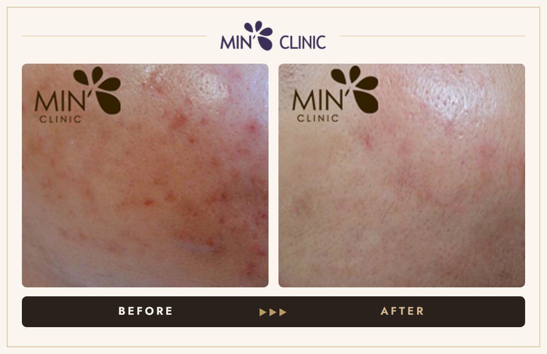 Acne before and after, case 57 – MIN Clinic Seoul