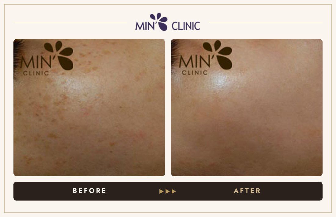 Pigmentation before and after, case 26 – MIN Clinic Seoul
