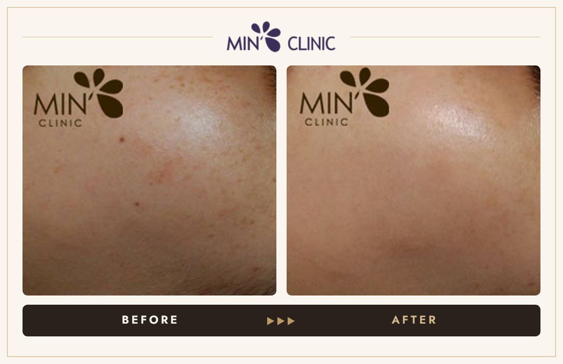 Pigmentation before and after, case 27 – MIN Clinic Seoul