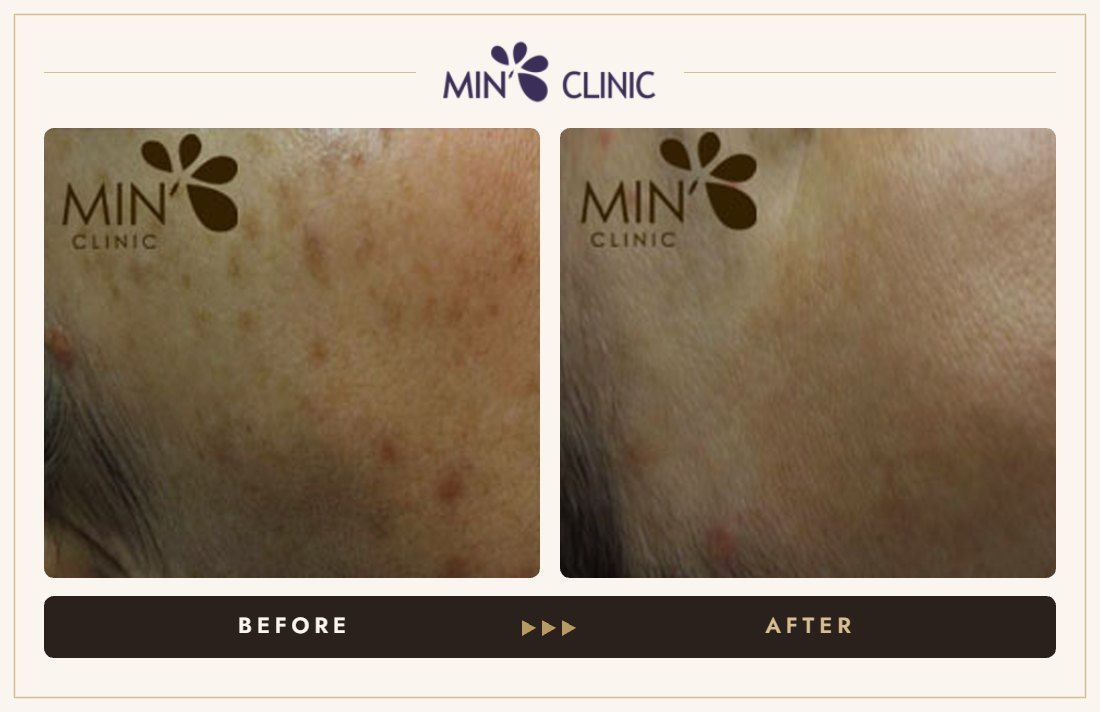 Acne, pores & pigmentation before and after, case 2 – MIN Clinic Seoul