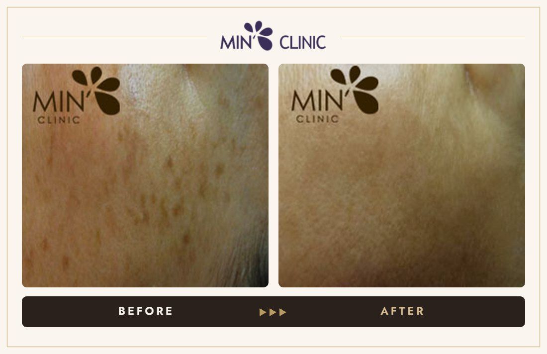 Pigmentation before and after, case 28 – MIN Clinic Seoul