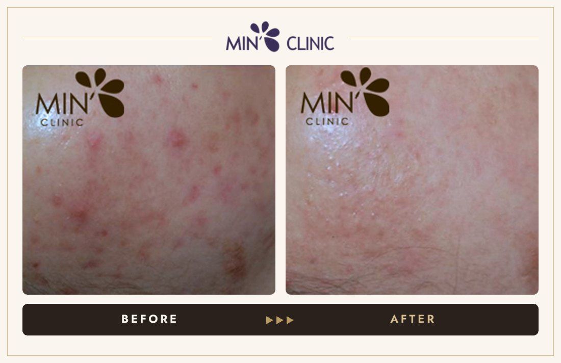 Acne, pores & pigmentation before and after – MIN Clinic Gangnam, Seoul