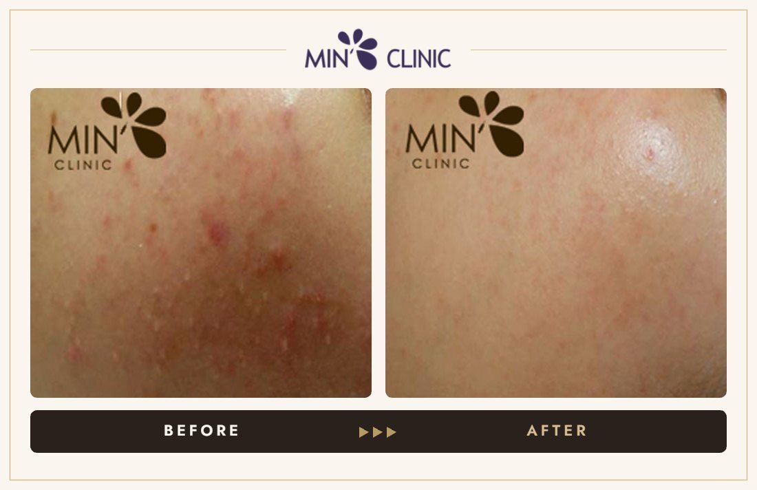 Acne before and after, case 29 – MIN Clinic Seoul