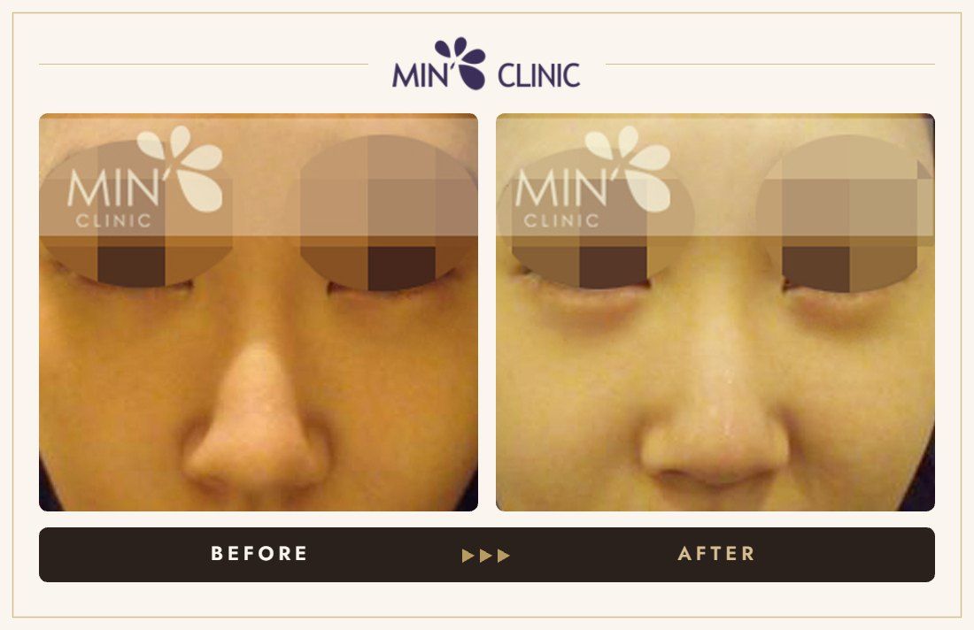 Aegyo-sal filler before and after, case 1 – MIN Clinic Seoul