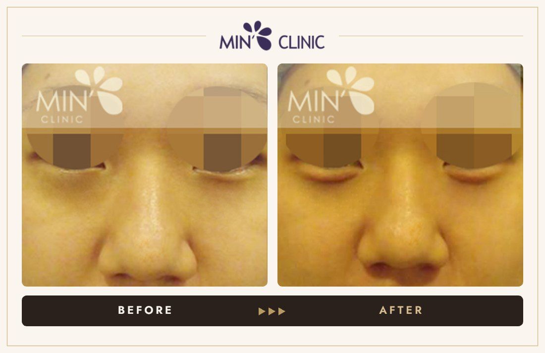Aegyo-sal filler before and after, case 2 – MIN Clinic Seoul