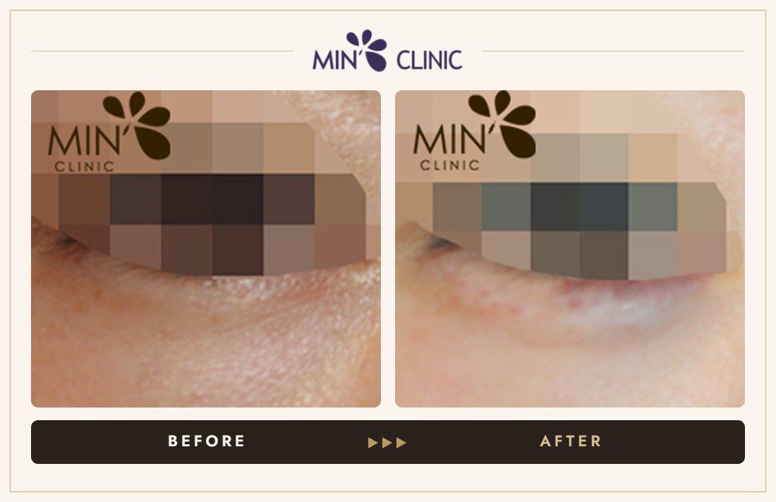 Aegyo-sal filler before and after, case 3 – MIN Clinic Seoul