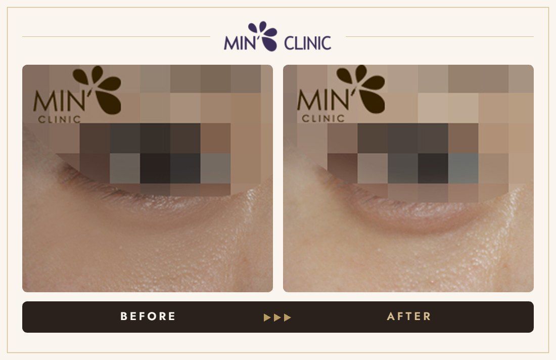 Aegyo-sal filler before and after, case 4 – MIN Clinic Seoul