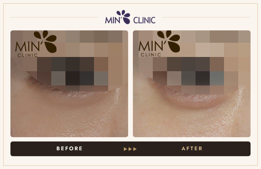 Aegyo-sal filler before and after, case 5 – MIN Clinic Seoul