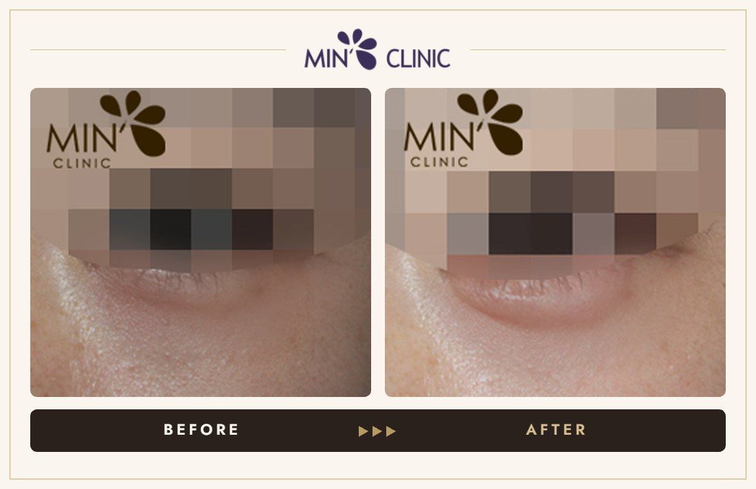 Aegyo-sal filler before and after, case 6 – MIN Clinic Seoul