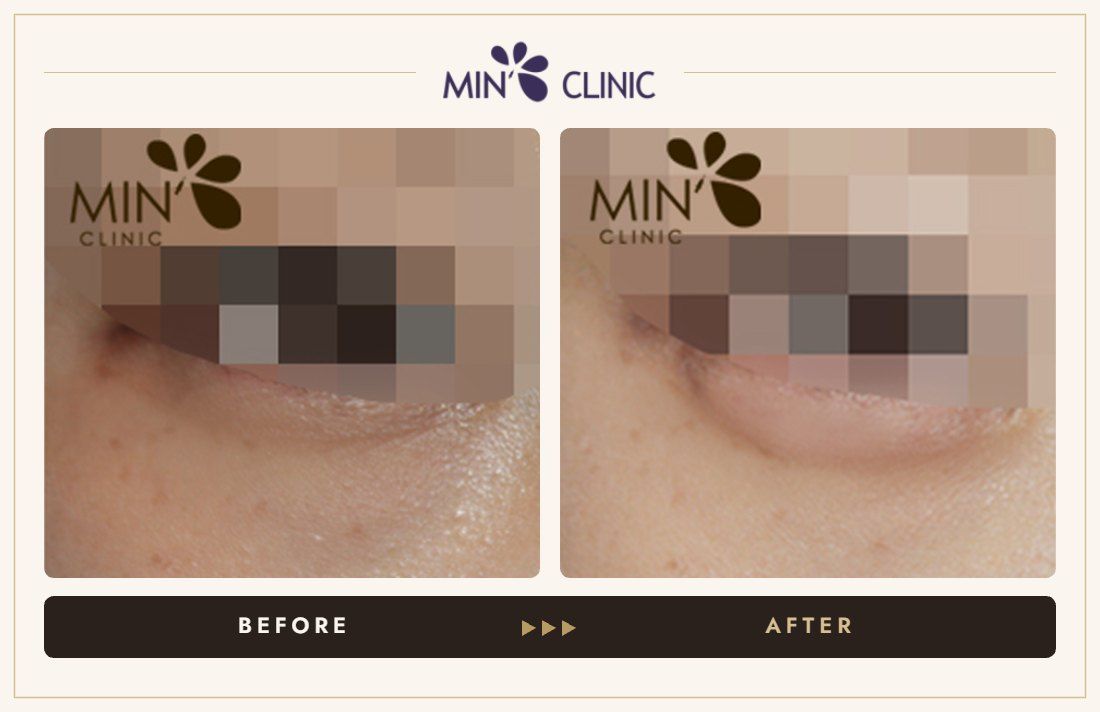 Aegyo-sal filler before and after, case 7 – MIN Clinic Seoul