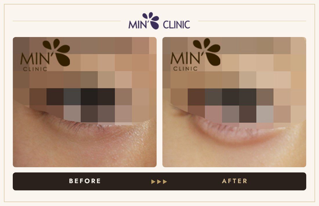 Aegyo-sal filler before and after, case 8 – MIN Clinic Seoul