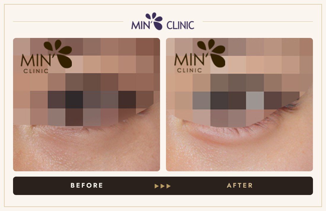 Aegyo-sal filler before and after, case 9 – MIN Clinic Seoul