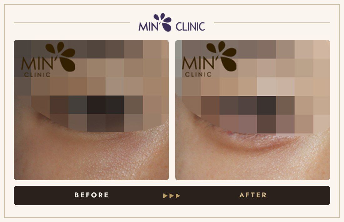 Aegyo-sal filler before and after, case 10 – MIN Clinic Seoul