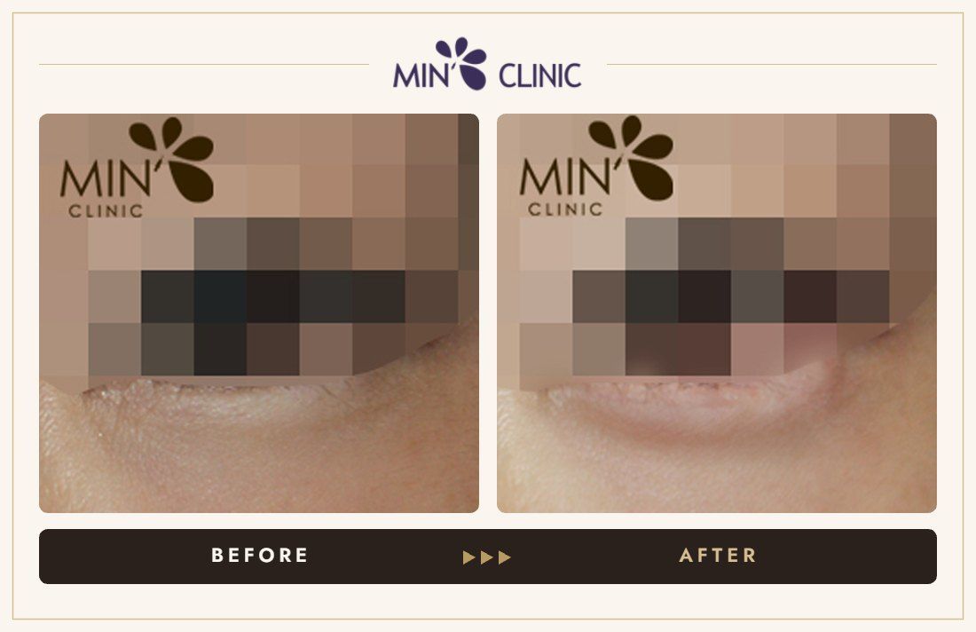 Aegyo-sal filler before and after, case 11 – MIN Clinic Seoul
