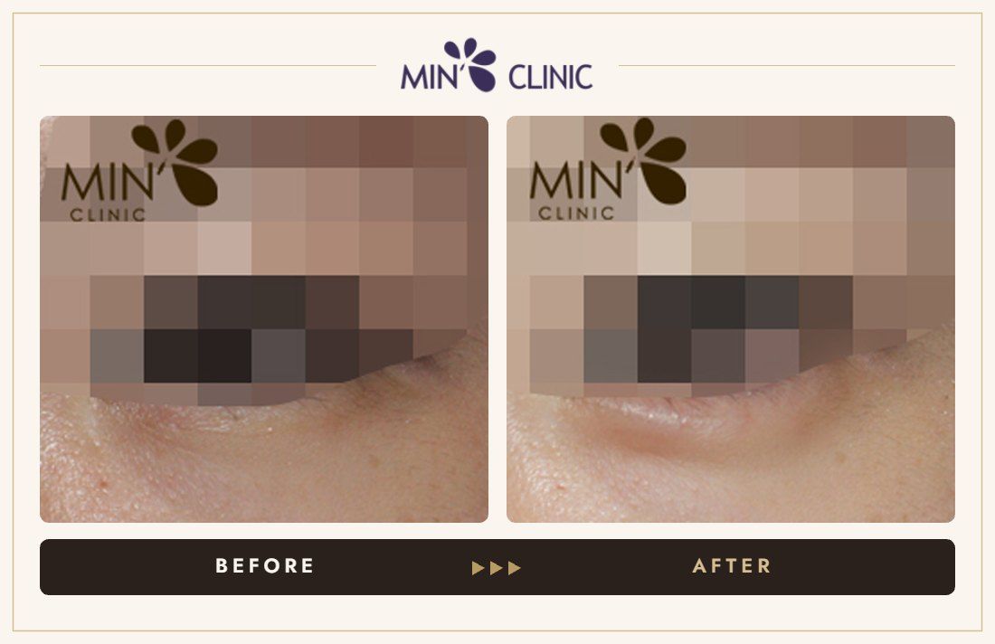 Aegyo-sal filler before and after, case 12 – MIN Clinic Seoul