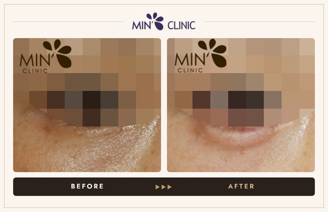 Aegyo-sal filler before and after, case 13 – MIN Clinic Seoul