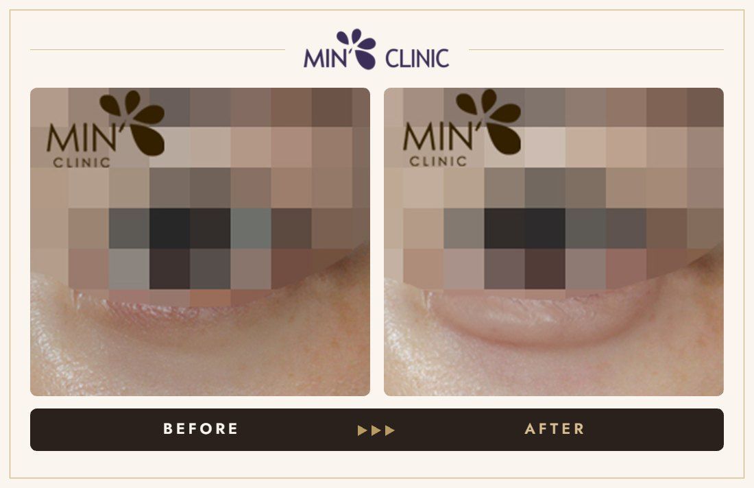 Aegyo-sal filler before and after, case 14 – MIN Clinic Seoul
