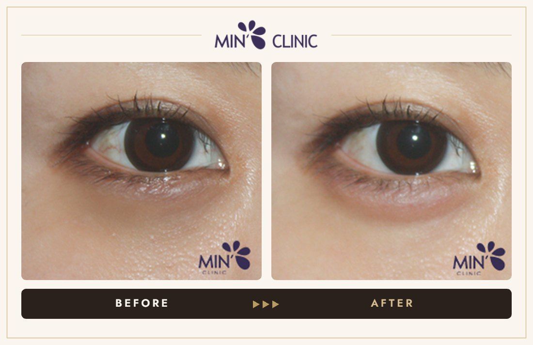 Aegyo-sal filler before and after, case 15 – MIN Clinic Seoul