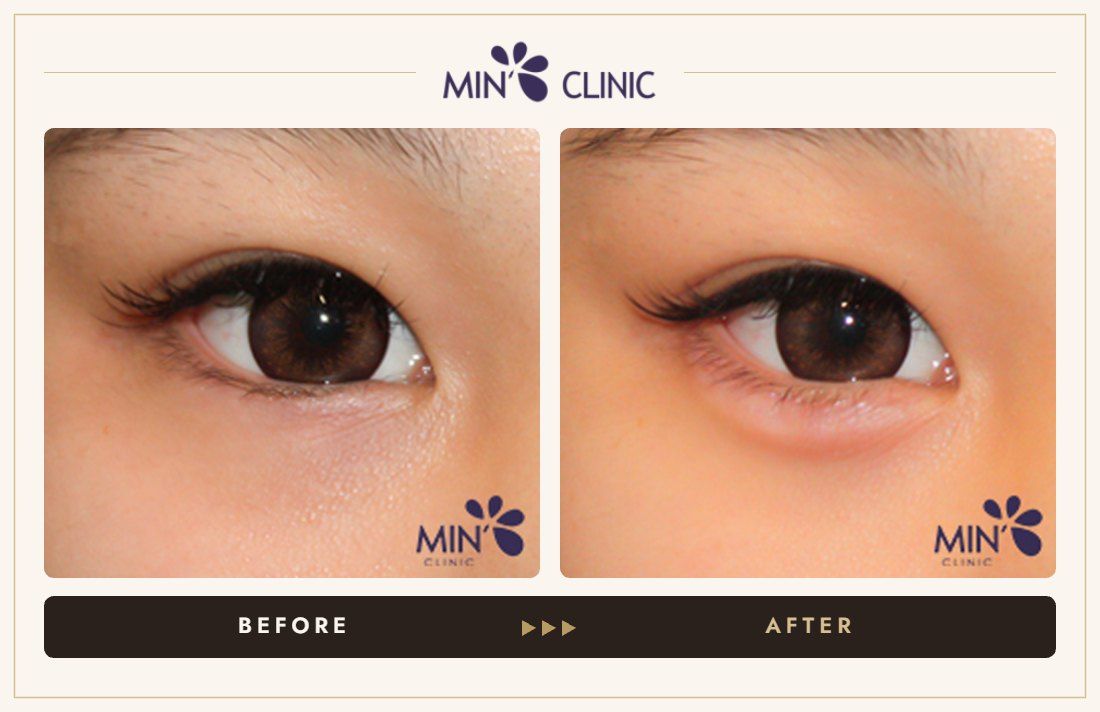 Aegyo-sal filler before and after, case 16 – MIN Clinic Seoul