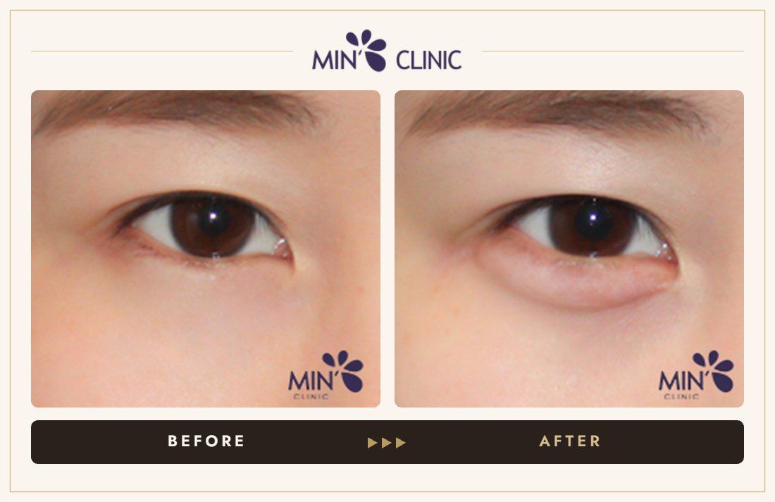 Aegyo-sal filler before and after, case 17 – MIN Clinic Seoul
