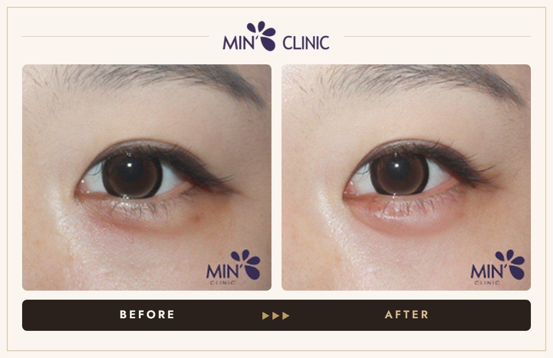 Aegyo-sal filler before and after, case 18 – MIN Clinic Seoul