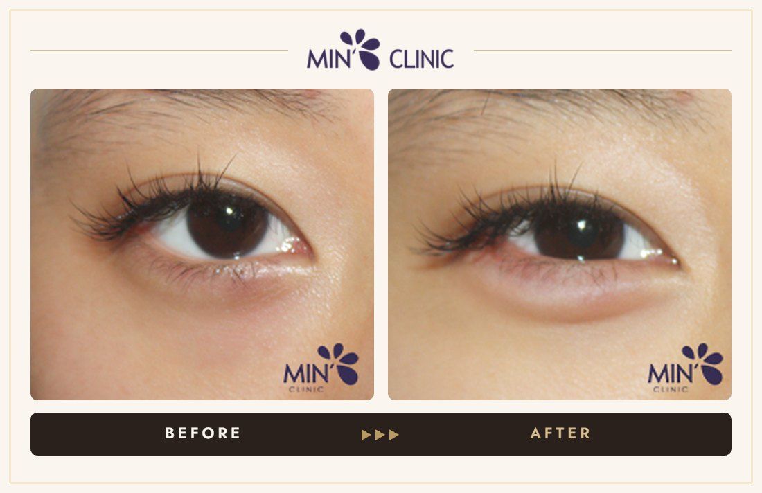 Aegyo-sal filler before and after, case 19 – MIN Clinic Seoul
