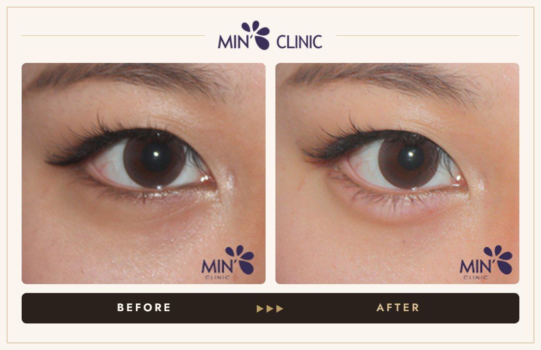 Aegyo-sal filler before and after, case 20 – MIN Clinic Seoul